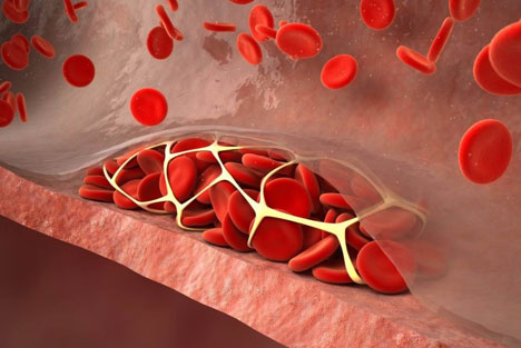 Treatment  for venous thromboembolism in children