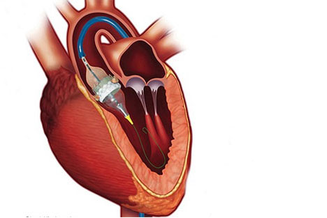 Transcatheter Aortic Valve Implantation/Replacement (TAVI/TAVR)