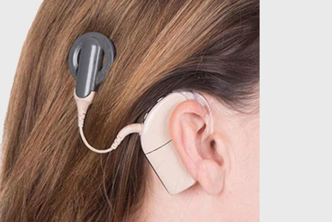 Cochlear Implant