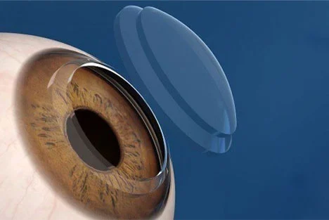 Cornea Transplant (Keratoplasty)