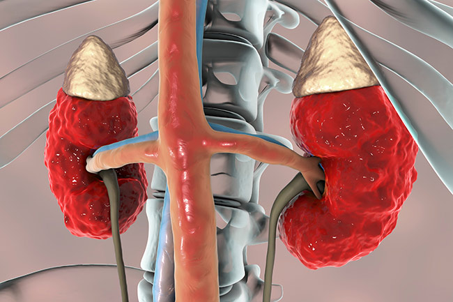 Chronic Kidney Disease