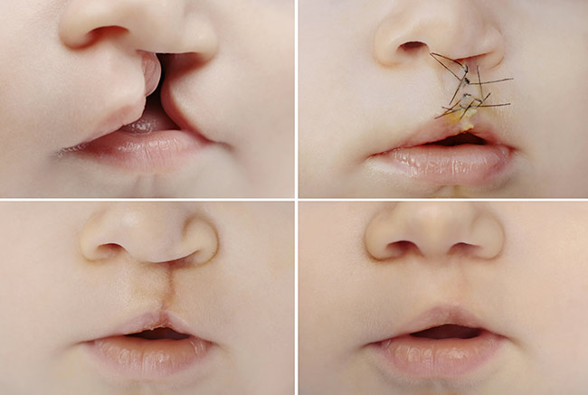 Cleft Lip & Cleft Palate