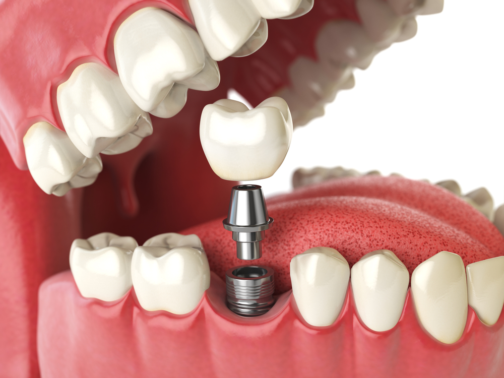 Dental-Implants