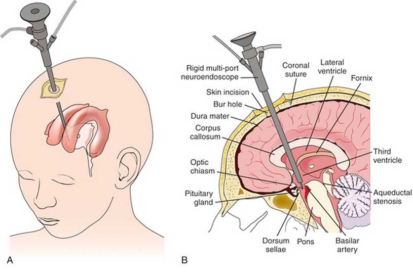 Endoscopic