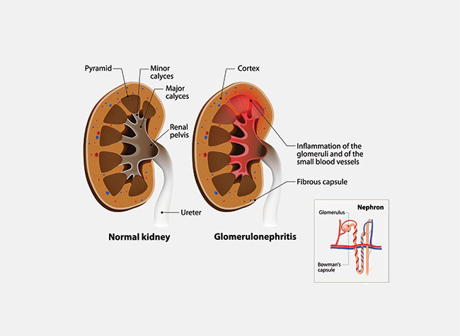 Glomerulonephritis