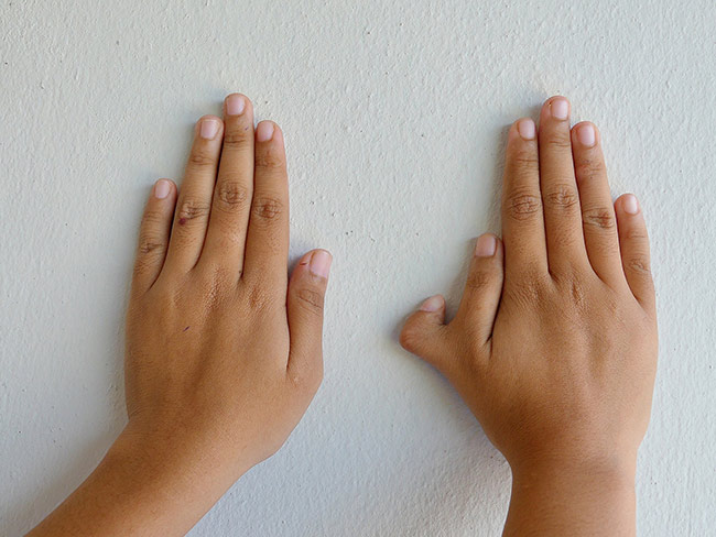 Hand Replantation