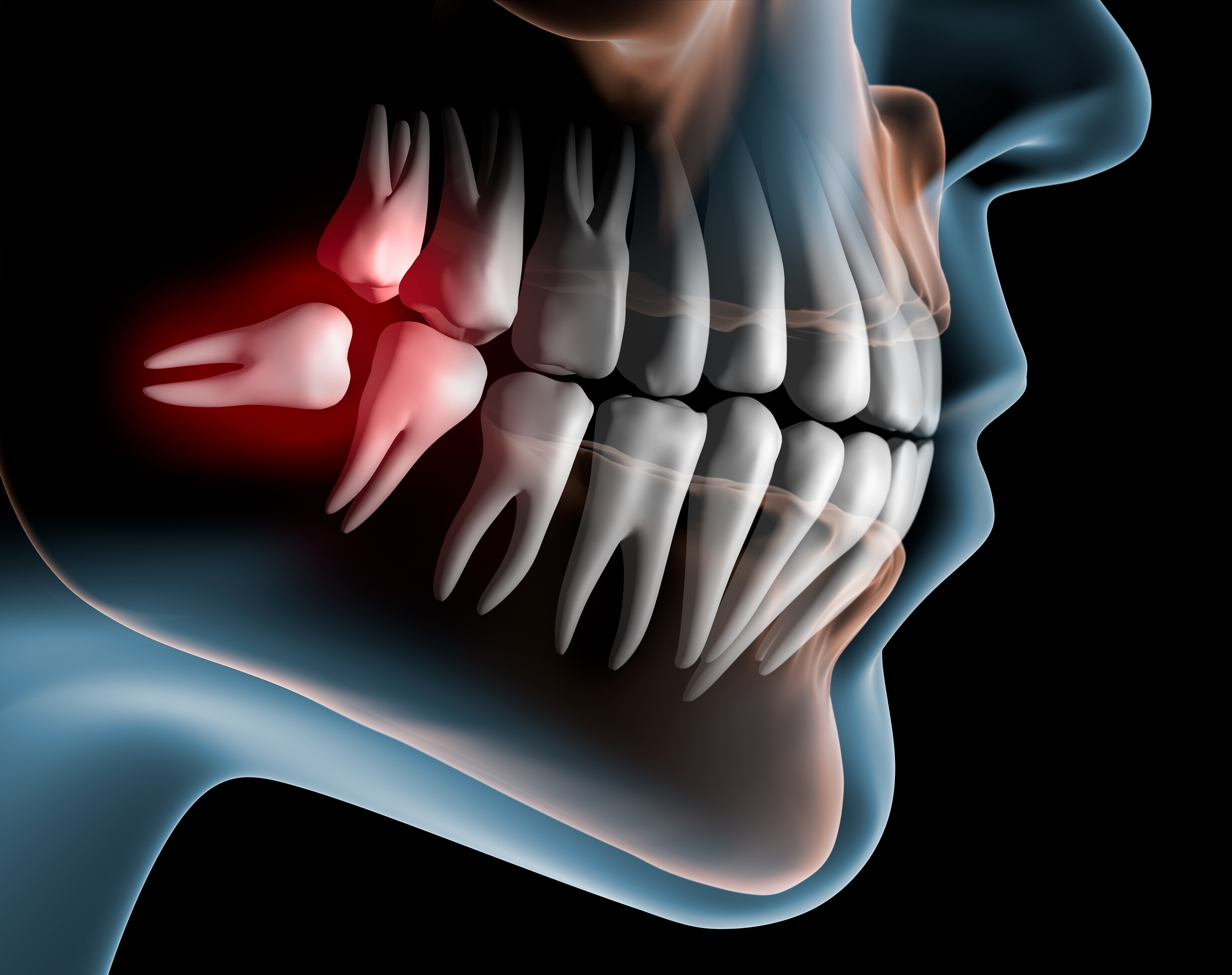 Impacted-wisdom-tooth