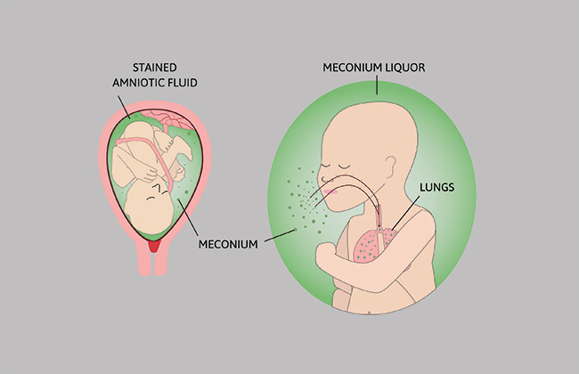 Meconium Aspiration Syndrome