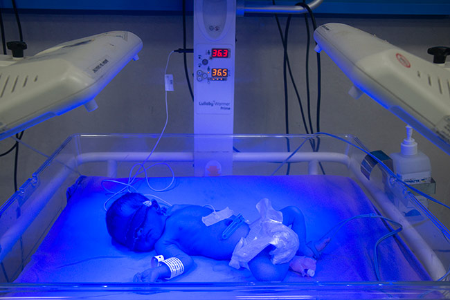 Neonatal Jaundice