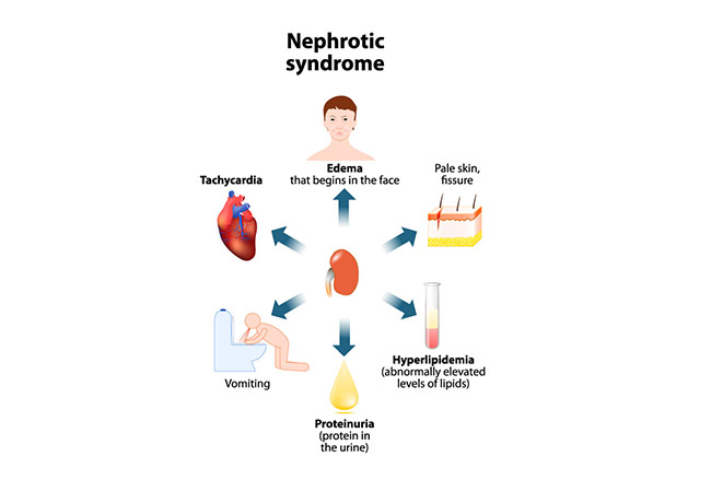 Nephrotic Syndrome