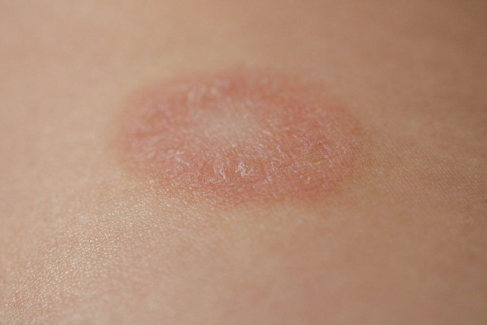 Pityriasis Rosea