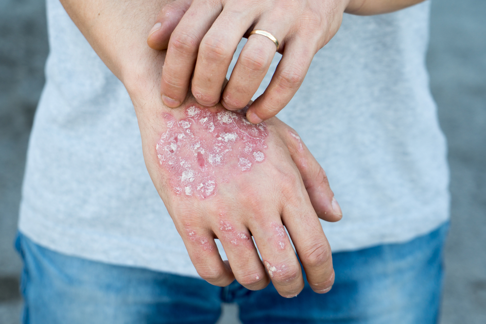 Psoriasis Vulgaris