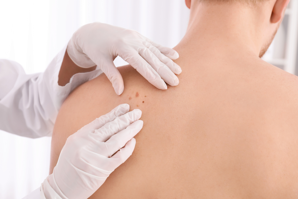 Skin-Biopsy