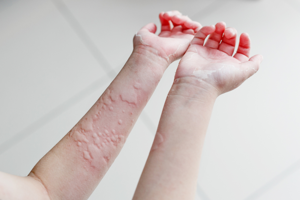 Urticaria