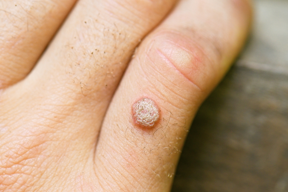 WART