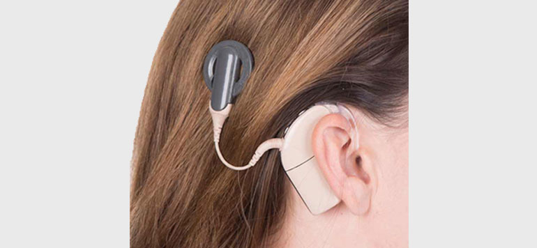 Cochlear Implant