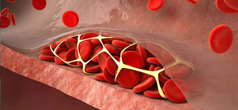 Treatment for venous thromboembolism in children