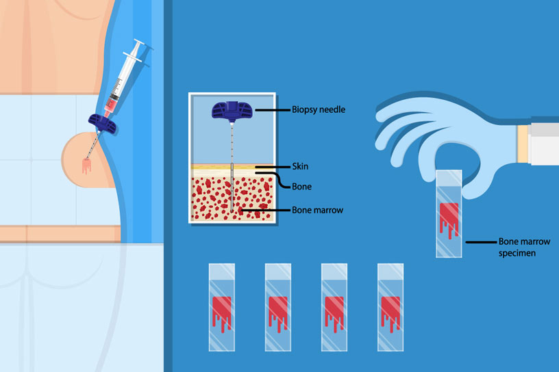 bone-marrow-aspiration