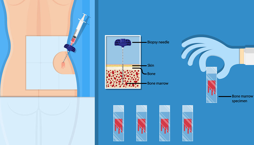 Bone Marrow Biopsy And Aspiration Mayo Clinic 56 OFF