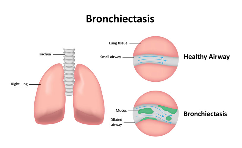 bronchiectasis