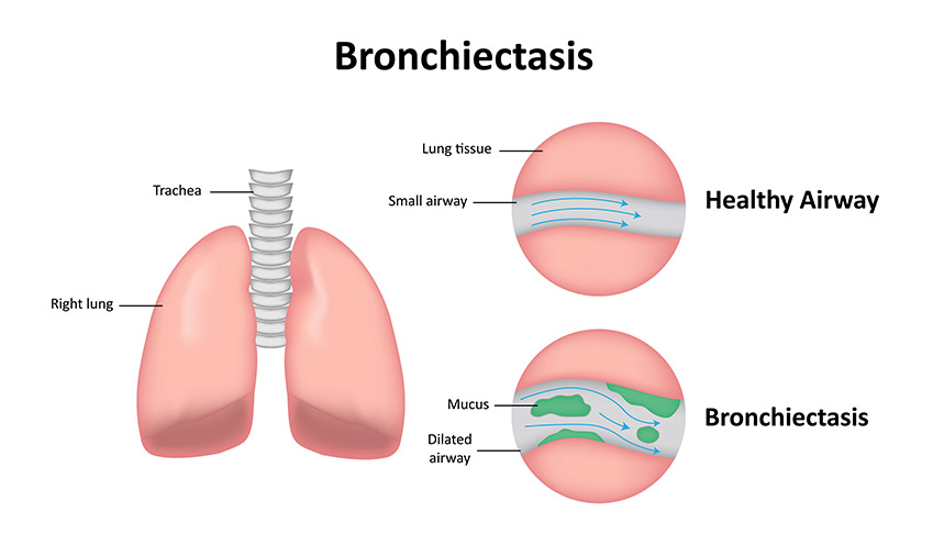 bronchoscope