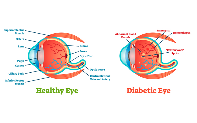 Diabetic Retinopathy