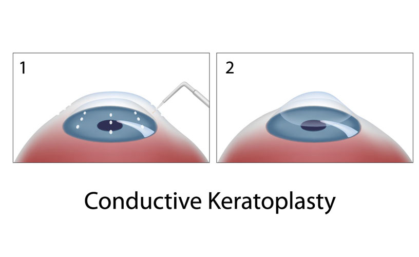 keratoplasty