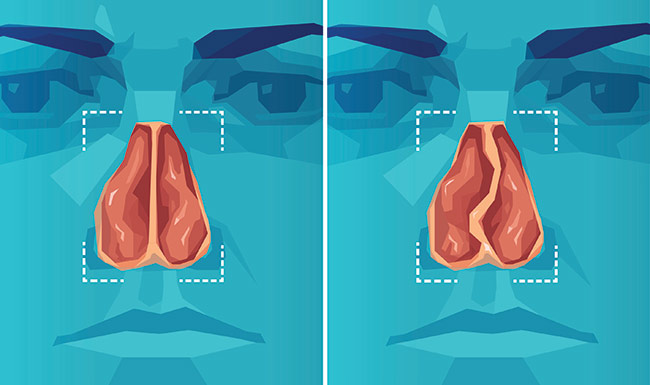 Nasal Framework Abnormalities