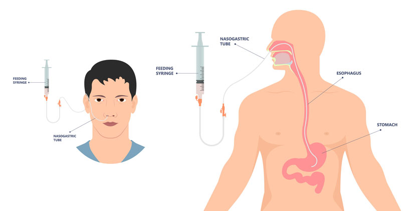 nasogastric