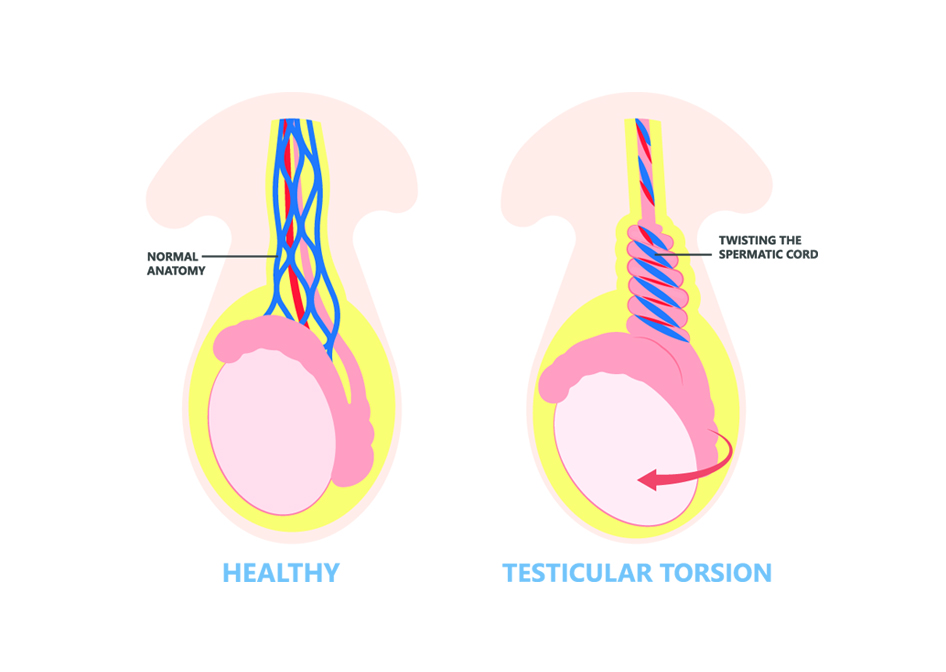 Testicular Torsion