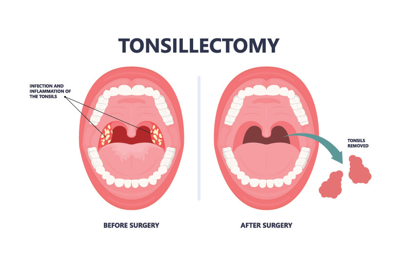 tonsillectomy