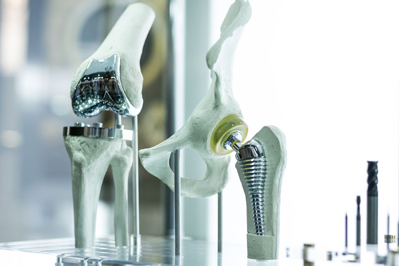  All You Need to Know About Knee Replacement Surgery