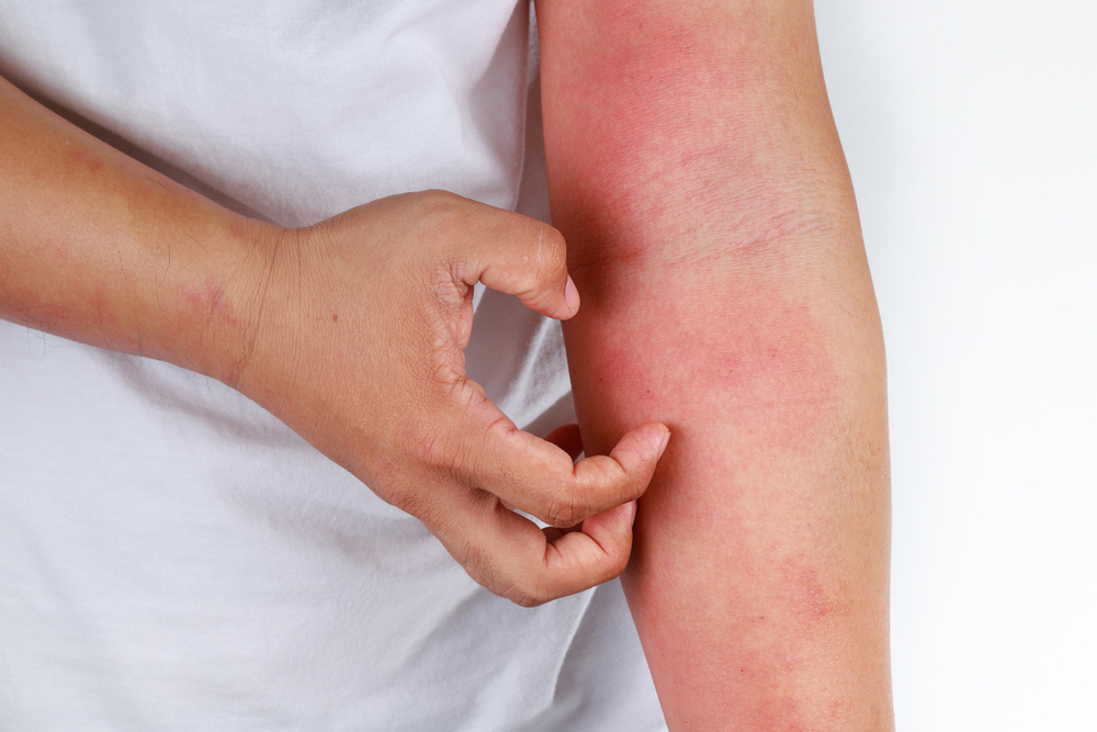 Dermatitis Herpetiformis