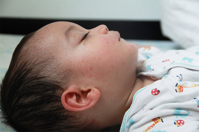 Febrile Seizure